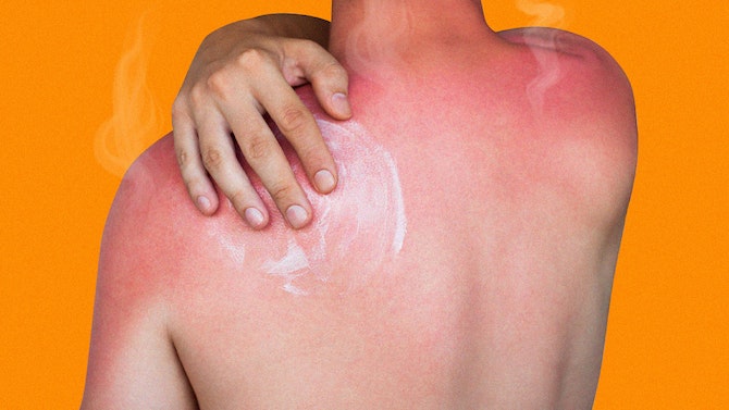 Can You ‘Feel’ Yourself Getting Sunburned?